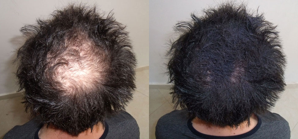 can stem cells regrow hair